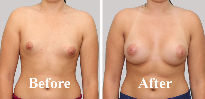 Enlargement Of The Breast In A Female in Delhi Before After Photo