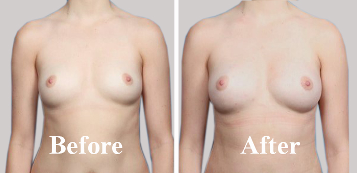 Breast Fat Transfer Procedure And Recovery in Delhi Before After Photo