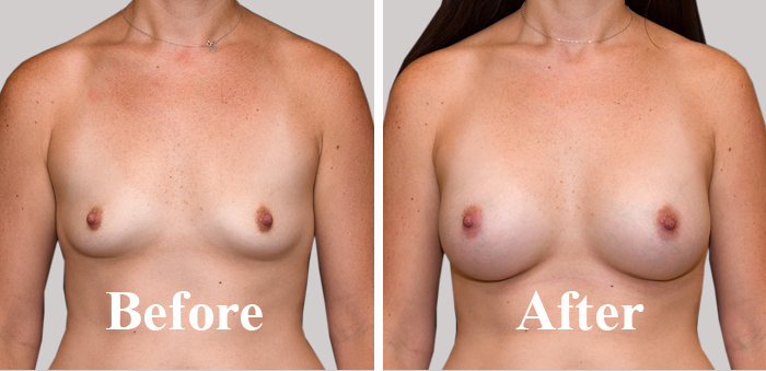Causes Of Breast Fat Transfer Procedure In Women in Delhi Before After Photo