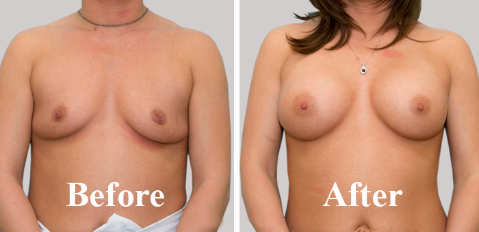 Fat Transfer to Breast Clinic in India Before After