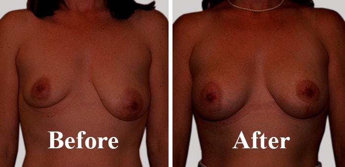 Correct Asymmetric Breasts & get the perfect round shape