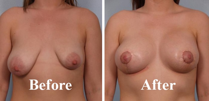 Asymmetric Breasts Cosmetic Surgery Before After Photo