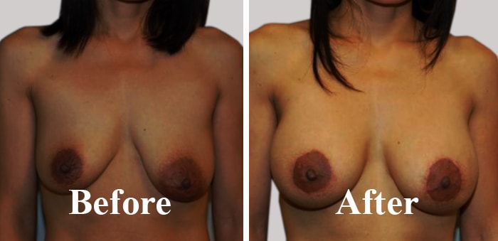 Best Hospital For Breasts Asymmetric Correction in India