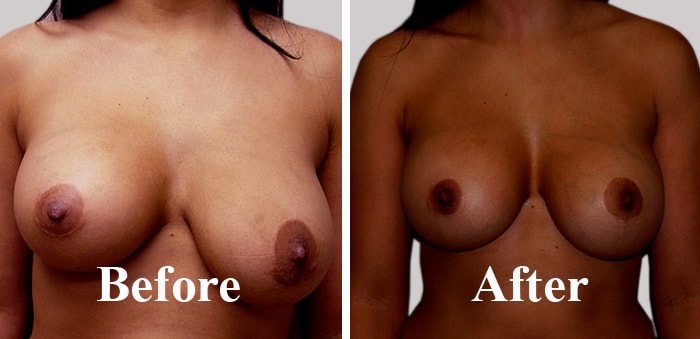 Asymmetric and Uneven Breasts Correction Surgery Before After