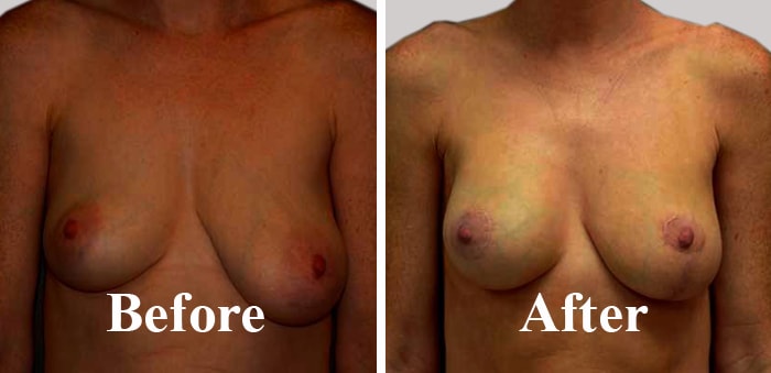 Asymmetric and Uneven Breasts Correction Clinic in India Before After