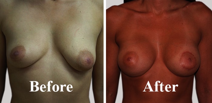 Get best Asymmetric and Uneven Breasts Correctioning surgery in India at low costs