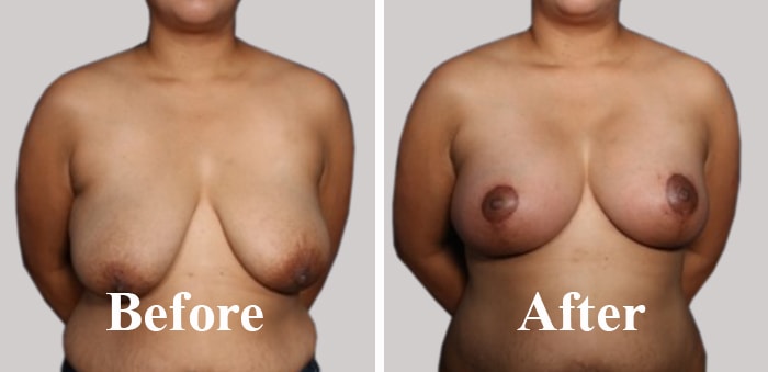 Best Surgeon For Breast Sagging in BHOPAL Before After