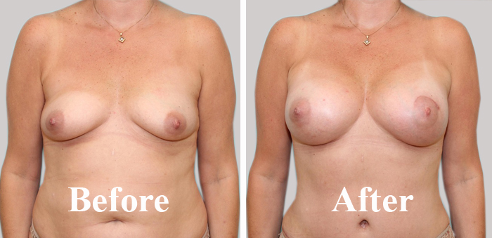 Breast Enlargement by Fat Grafting