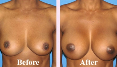 Breast Implant (Breast Surgery) Bhopal - Find cost of Breast Implant Before After Photo