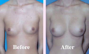 Breast Enlargement by Fat Grafting
