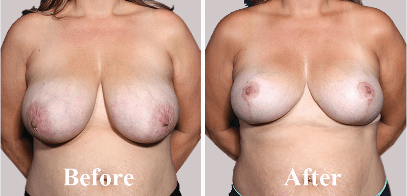 Best Hospital For Breast Reduction In India