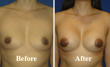 Silicone Breast Implant Cosmetic Surgery Before After Photo