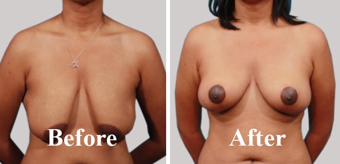 Breast Lift Surgery Before After