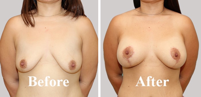 Tighten Sagging BreastLift Cosmetic Surgery Before After Photo