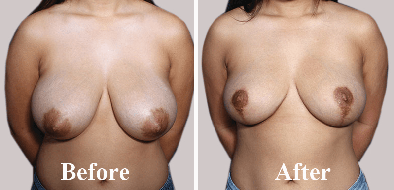 Female Breast Reduction Cosmetic Plastic Surgery Before After Photo