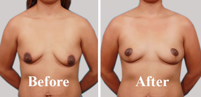 Best Hospital For Breasts Asymmetric Correction in India