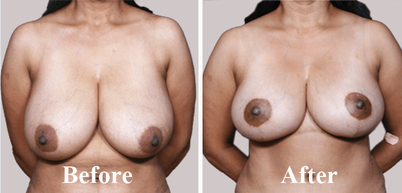 best breast reduction surgery in India at low costs