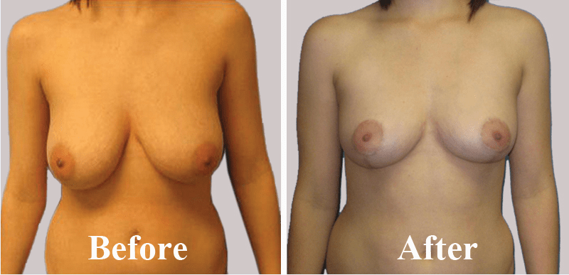 Women Breast size reduction cosmetic surgery in India