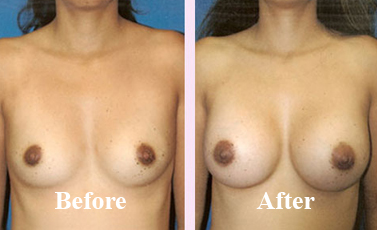 Breast Reduction For Women Cost in Delhi Before After