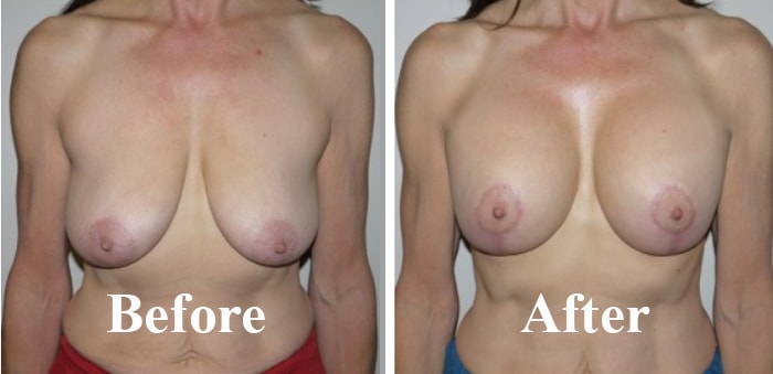 Causes Of Breast Sagging In Older Women in Delhi Before After Photo