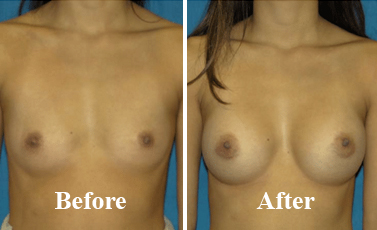 Breast Surgery Medication Causes Noida Before After Photo