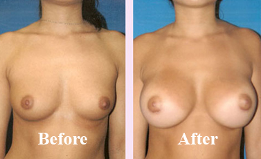 Causes Of Gynaecomastia In Women in Delhi Before After Photo