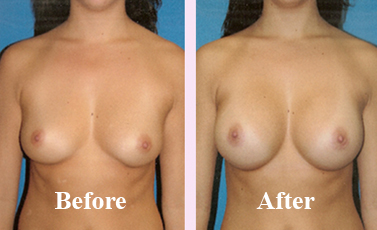 Breast Reduction Cost For Women in Delhi Before After