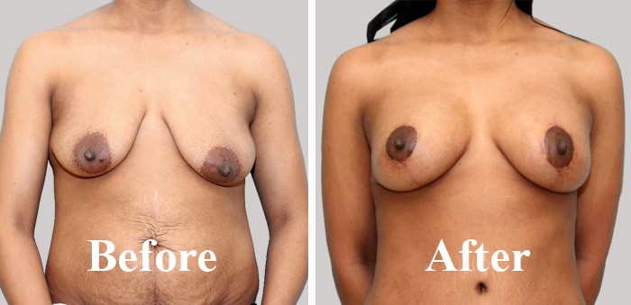 Cost Breast Lift in Delhi Before After
